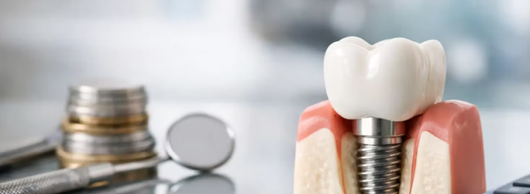 Maqueta de un implante dental junto a una pila de monedas y un espejo dental, simbolizando el costo y la inversión en salud oral.