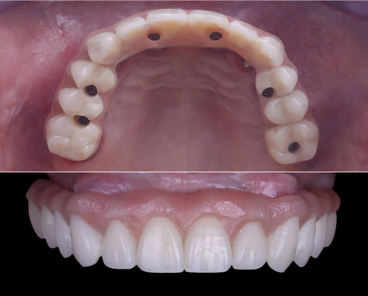 Fotografía clínica de una prótesis dental híbrida superior completa, diseñada para el sistema All-on-6. La imagen superior muestra la vista oclusal de la prótesis, revelando los seis orificios de acceso a los tornillos de fijación sobre los pilares de los implantes. La imagen inferior presenta una vista frontal de la misma prótesis, mostrando la estética natural de los dientes y la encía artificial perfectamente contorneada.