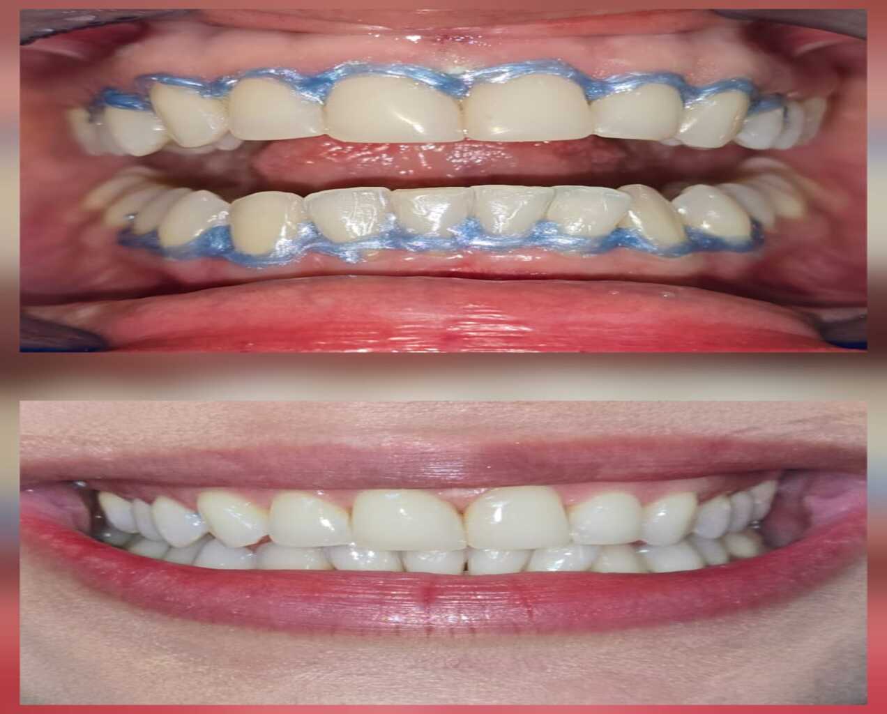 Fotografía en vista de díptico que muestra el "Antes y Después" de un tratamiento de blanqueamiento dental profesional. La imagen superior muestra la aplicación del gel blanqueador azul sobre los dientes, con el tejido gingival protegido. La imagen inferior muestra el resultado final, con los dientes notablemente más blancos, brillantes y saludables tras completar el procedimiento.