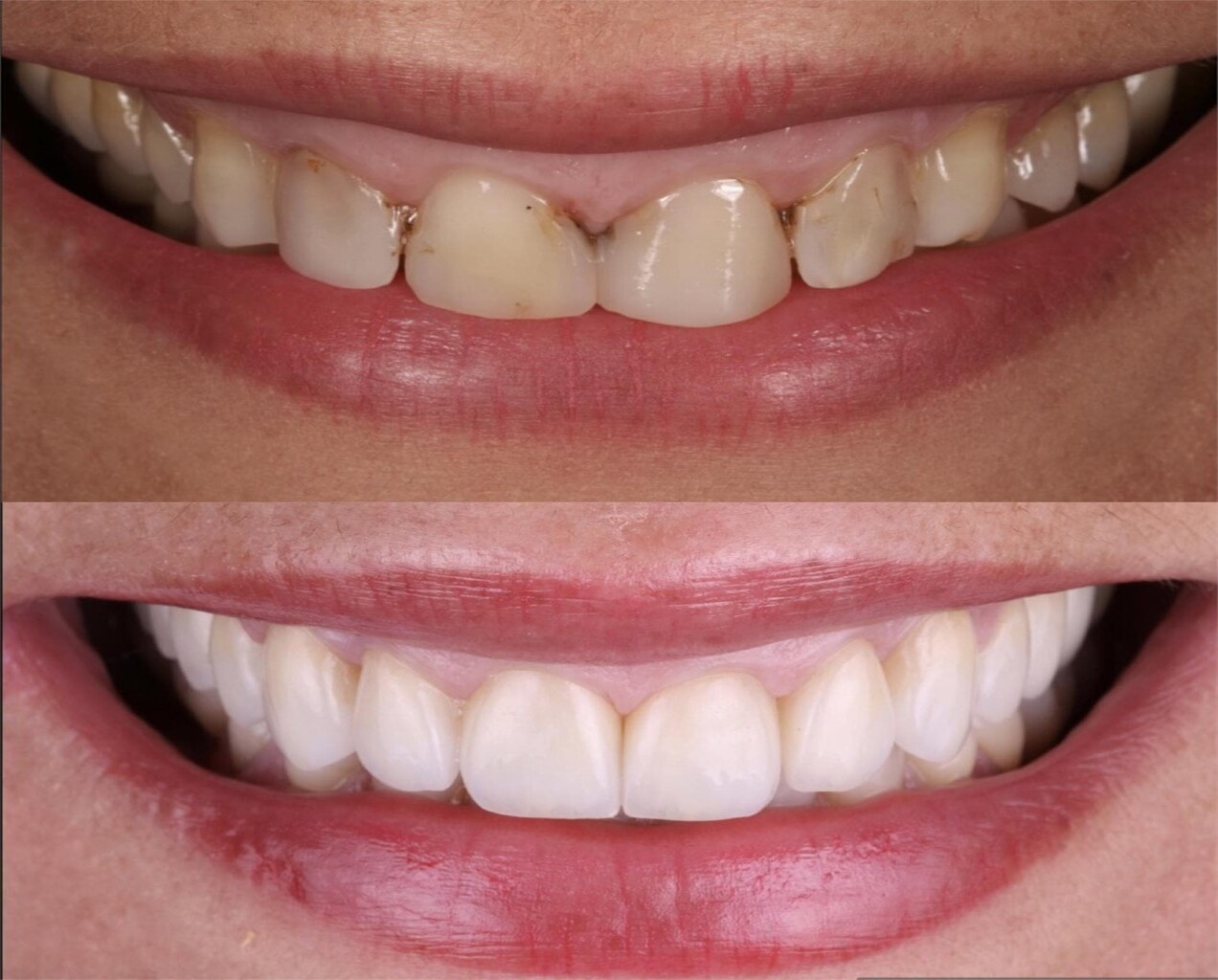 Fotografía comparativa en formato de díptico que muestra el antes y después de un tratamiento de carillas dentales. La imagen superior muestra una sonrisa con los dientes naturales desgastados y con manchas. La imagen inferior muestra el resultado final, con una sonrisa renovada compuesta por carillas dentales estéticas, alineadas, de tono uniforme y aspecto natural.