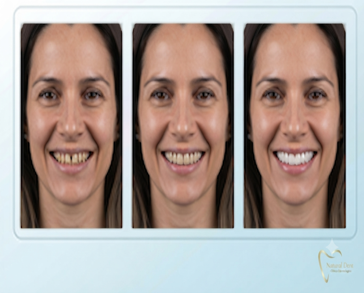 Tríptico fotográfico de Natural Dent que muestra la evolución de un diseño de sonrisa: a la izquierda, la sonrisa natural con pequeñas imperfecciones; en el centro, una prueba de carillas provisionales; a la derecha, el resultado final con carillas definitivas perfectamente alineadas y armoniosas.