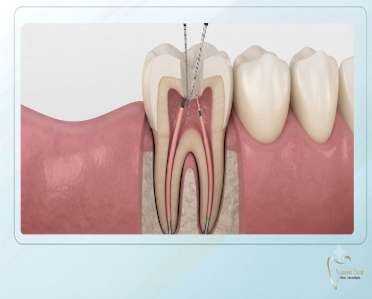 Ilustración médica de Natural Dent que muestra una sección transversal de un molar durante un procedimiento de endodoncia, destacando la limpieza y sellado de los conductos radiculares para salvar la pieza dental.