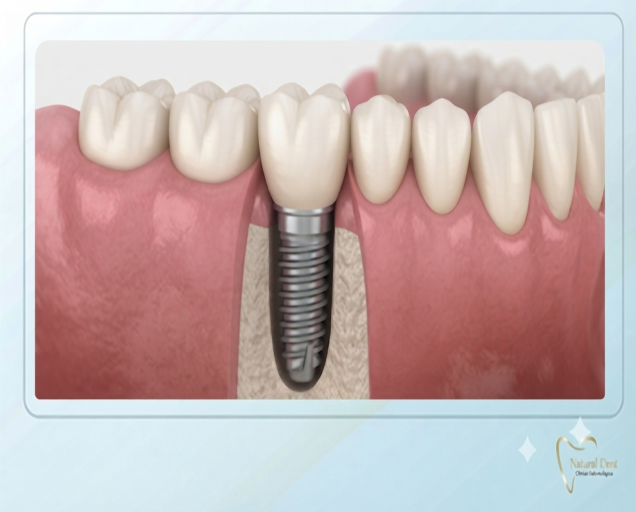 Ilustración clínica de Natural Dent que muestra un implante dental de titanio integrado en el hueso maxilar, sosteniendo una corona cerámica de aspecto natural que reemplaza una pieza dental ausente.