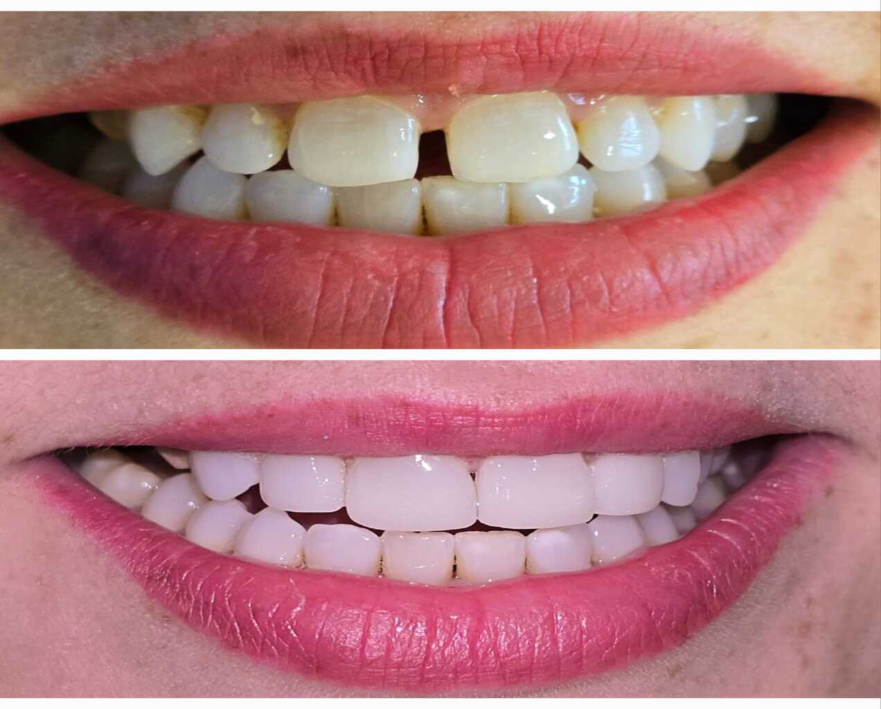 Fotografía de díptico que muestra el "Antes y Después" de una rehabilitación estética con laminados dentales (carillas). La imagen superior muestra los dientes naturales originales, con desgaste, coloración amarillenta y espacios interdentales. La imagen inferior muestra los mismos dientes cubiertos con carillas de porcelana perfectamente alineadas, de un blanco brillante y con una forma contorneada y uniforme.
