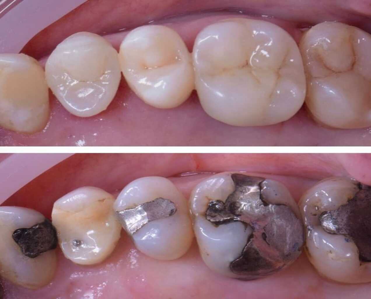 Fotografía comparativa de una arcada dental que muestra el "Antes y Después" de un tratamiento de obturaciones. La imagen inferior muestra múltiples dientes con amalgamas dentales (empastes metálicos oscuros) y caries. La imagen superior muestra los mismos dientes restaurados con composites estéticos (empastes blancos del color del diente) de aspecto natural.