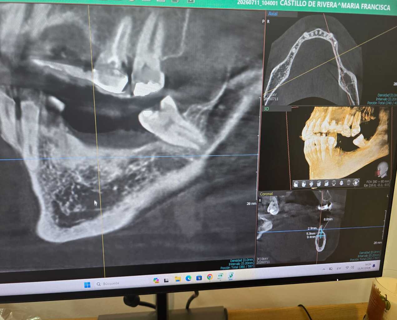 Fotografía de un monitor clínico que muestra un software de planificación con tomografía computarizada de haz cónico (CBCT). Se aprecian múltiples vistas de diagnóstico maxilofacial, incluyendo cortes axiales, coronales, una vista sagital detallada y una reconstrucción tridimensional de la mandíbula y los dientes.