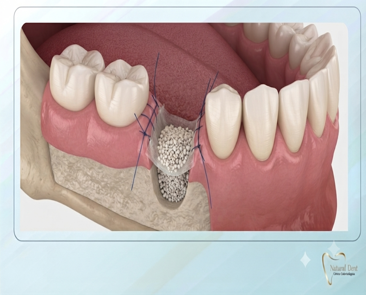 Ilustración clínica de alta resolución para Natural Dent que muestra en corte transversal el procedimiento de regeneración ósea y preservación alveolar. Se observa el alveolo (cavidad dental) relleno con material de injerto óseo y cubierto por una membrana, asegurado con suturas finas en la encía, con el fin de mantener el volumen óseo para futuros implantes.